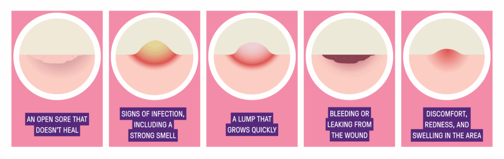 fungating breast cancer infographic | 1