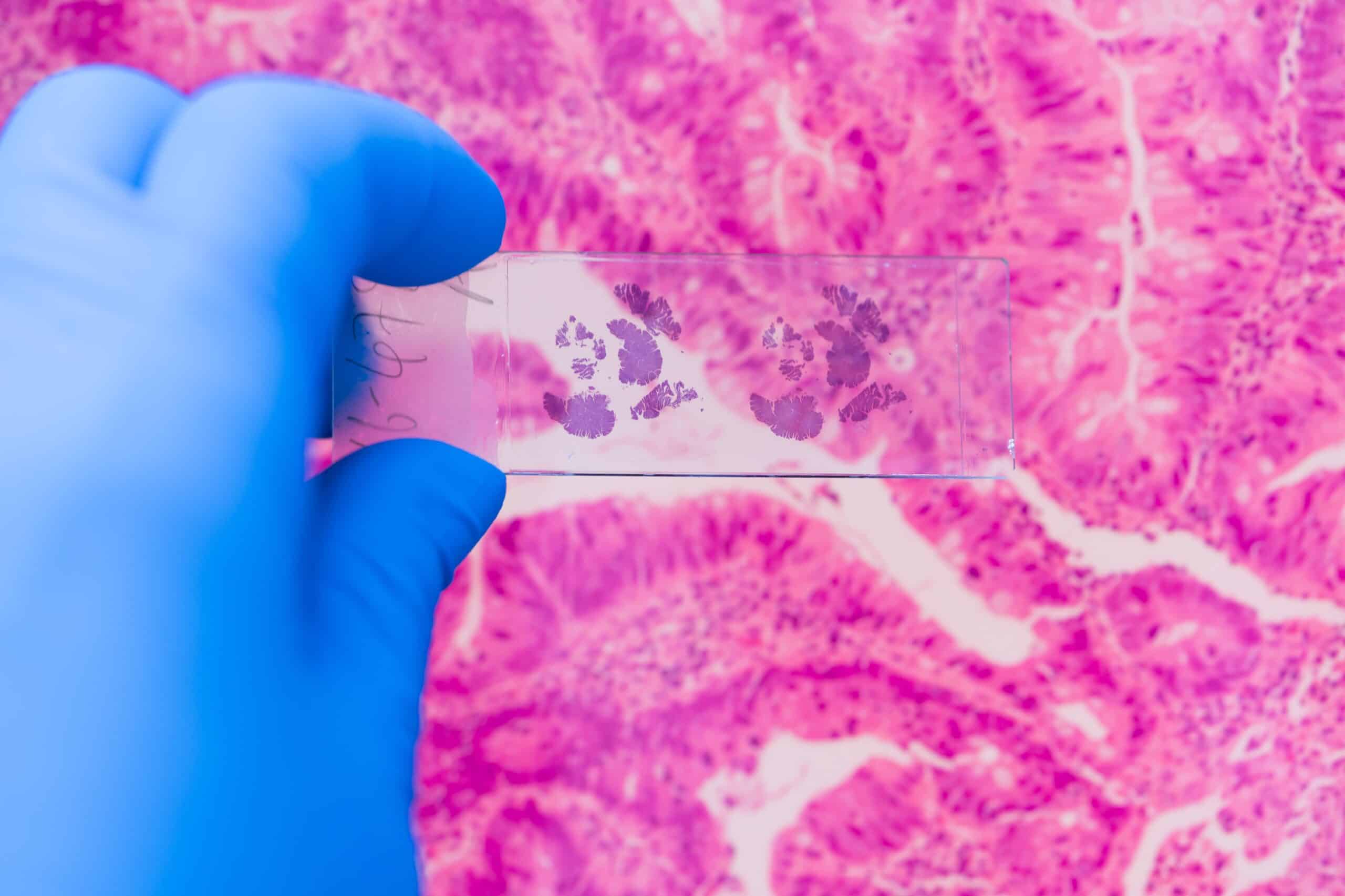 Clarifying the Role of HER2-Low in Early Breast Cancer
