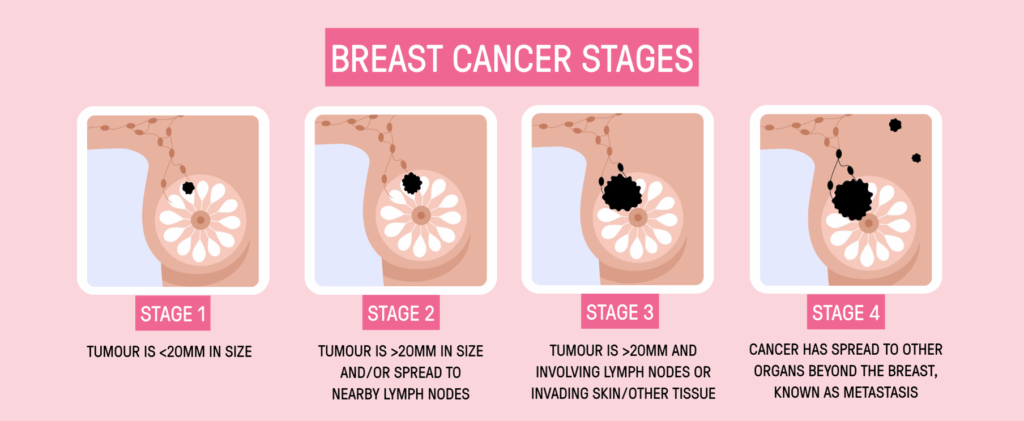 breast cancer stages infographic | 1