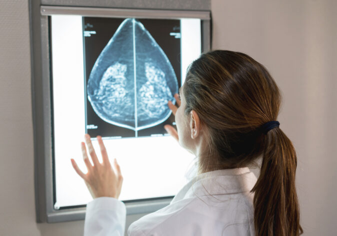 new breast cancer trial explores omission of radiotherapy