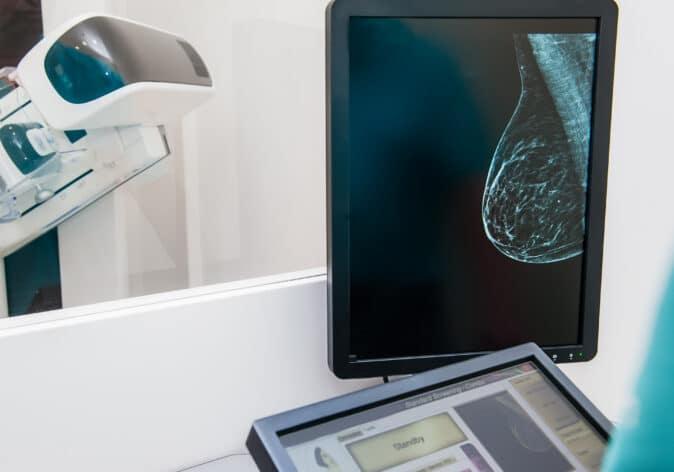 myscreen trial to personalise breast cancer screening